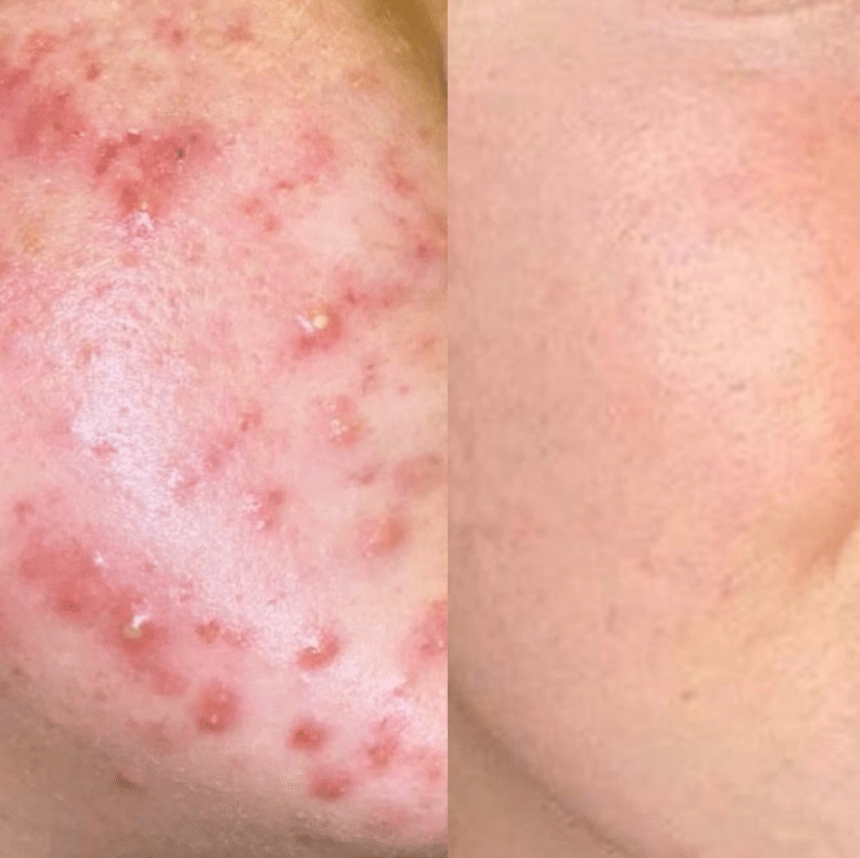 Side-by-side before and after of acne treatment.
