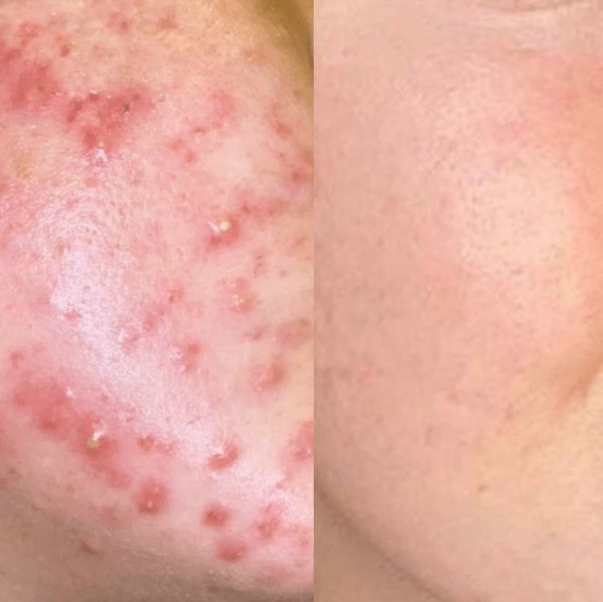 Side-by-side before and after of acne treatment.