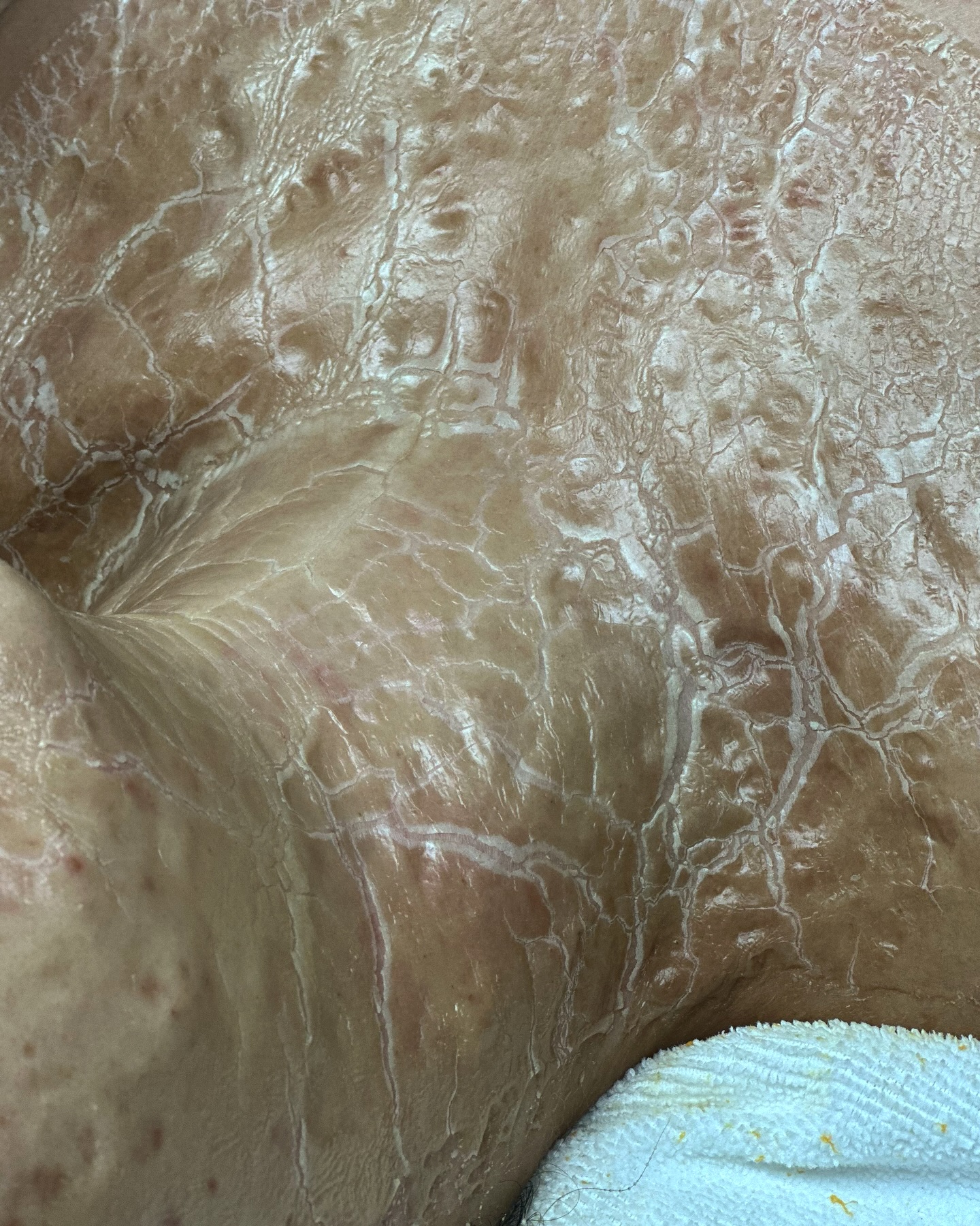 Close-up of cracked skin with light reflecting off surface.