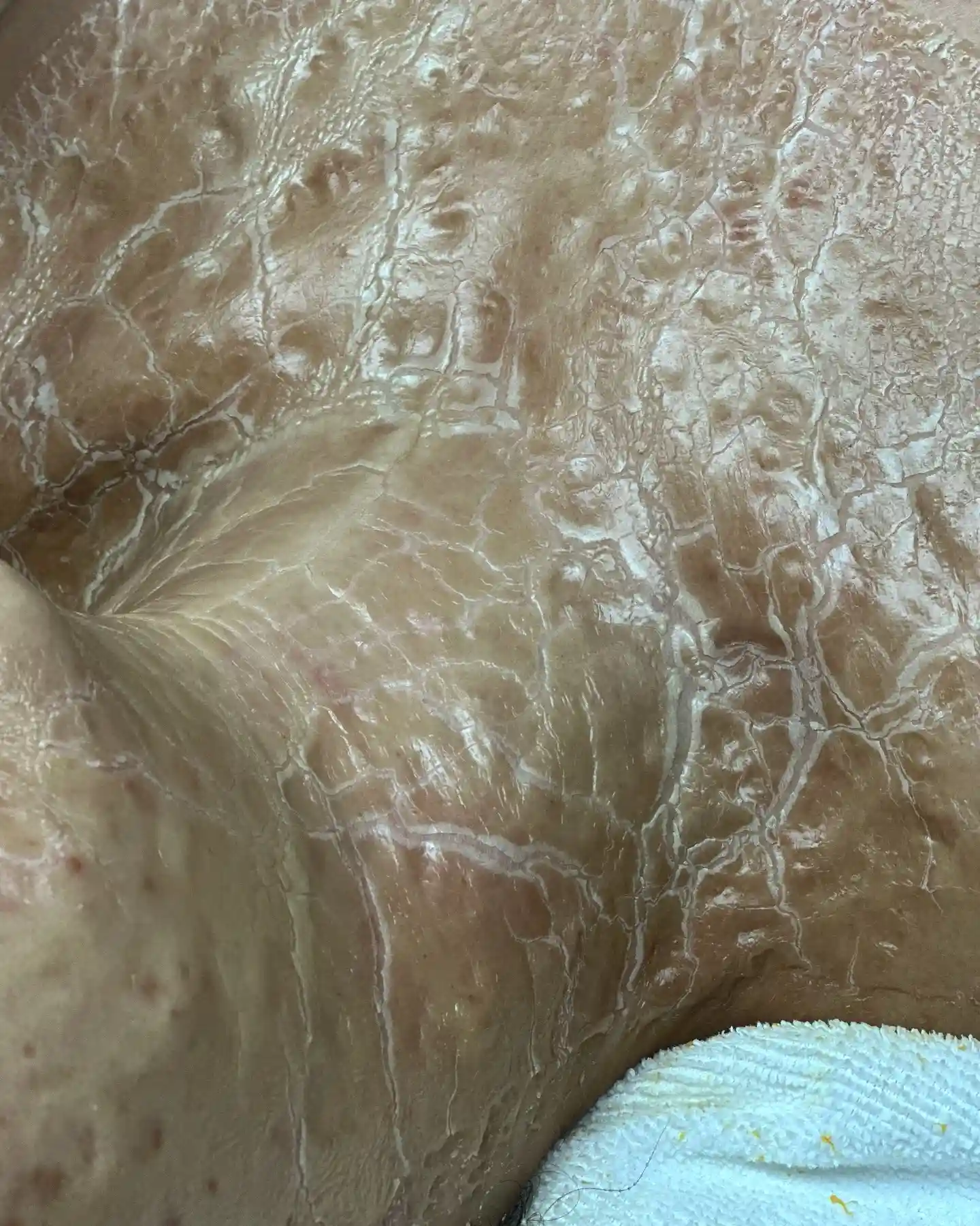 Close-up of cracked skin with light reflecting off surface.