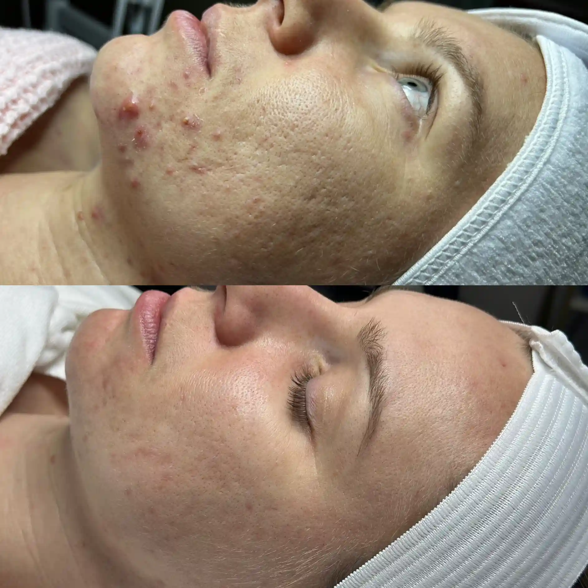 Before and after photos of skin with acne and scarring.