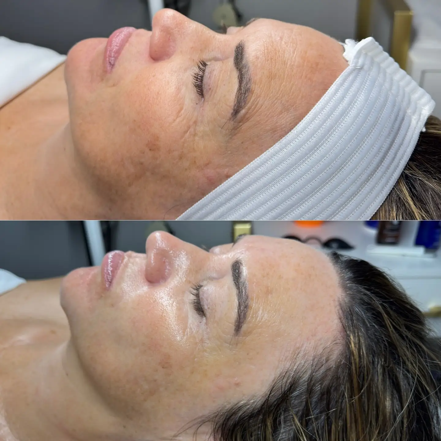 Side-by-side facial comparison at Skin Lounge Med Spa.