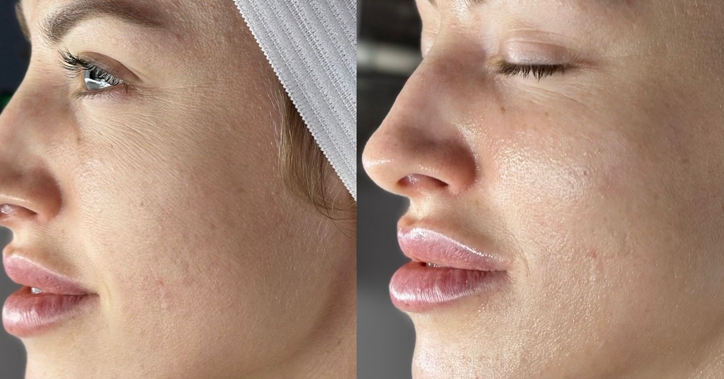 Side-by-side comparison of a face with and without treatment.