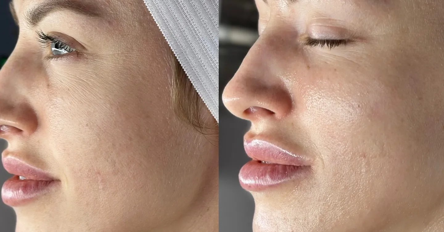 Side-by-side comparison of a face with and without treatment.