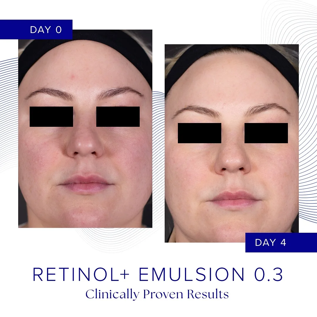 nn Day 0 and Day 4 facial comparison for Retinol+ Emulsion 0.3.