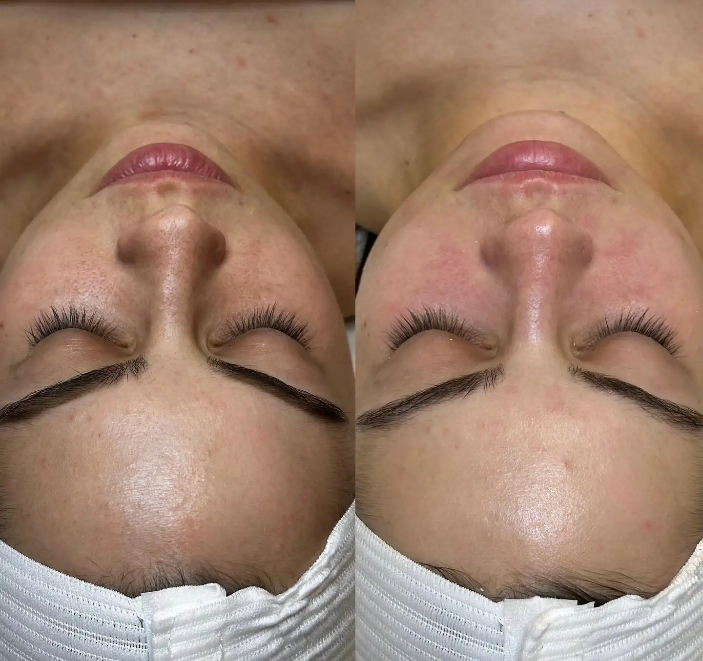 Before and after facial treatment at Skin Lounge Med Spa.