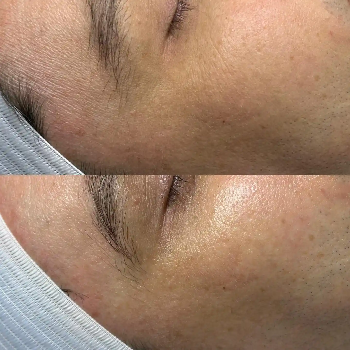 Before and after view of facial skin texture.