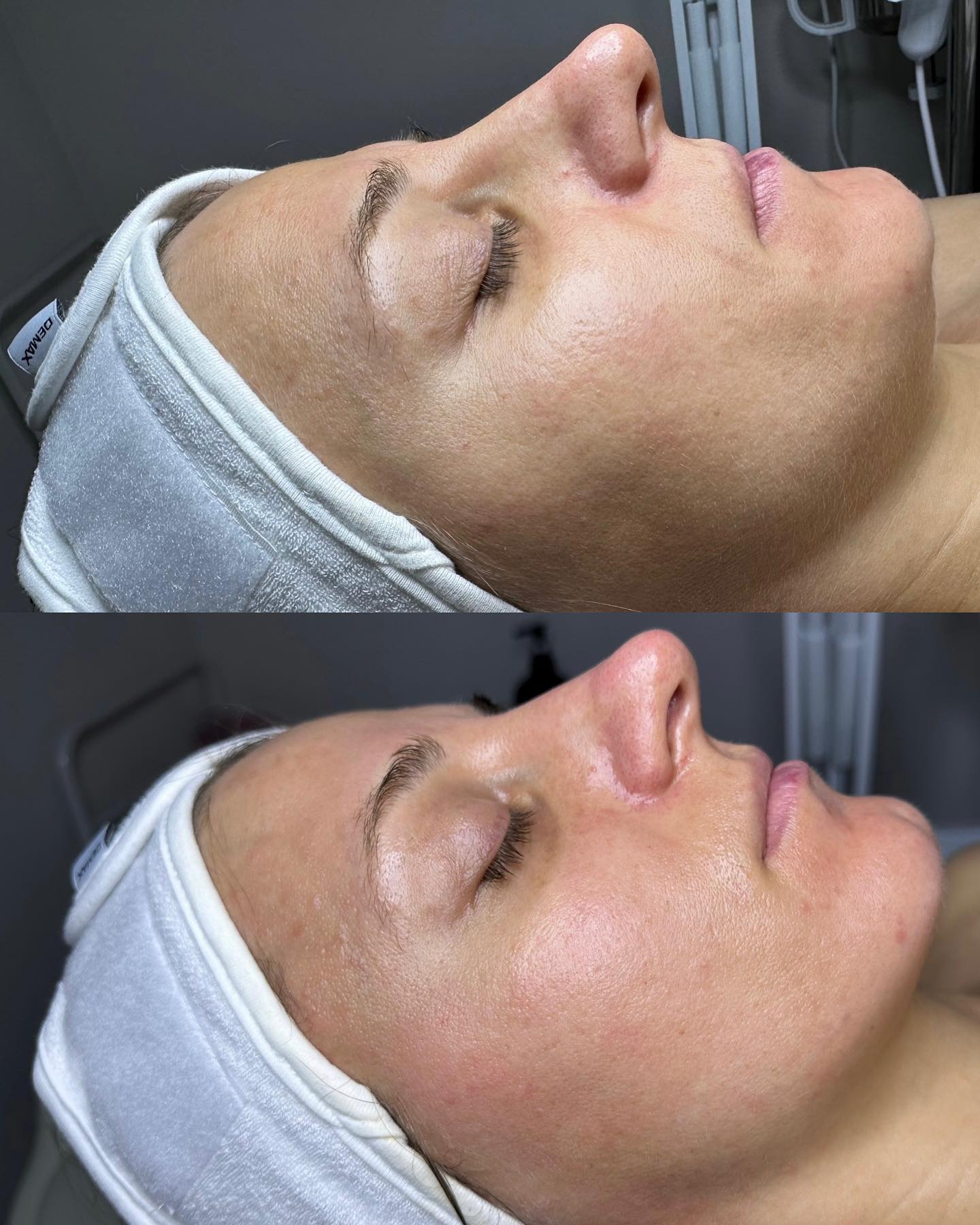 Side profile of a face with a white headband, DEMAX logo visible.