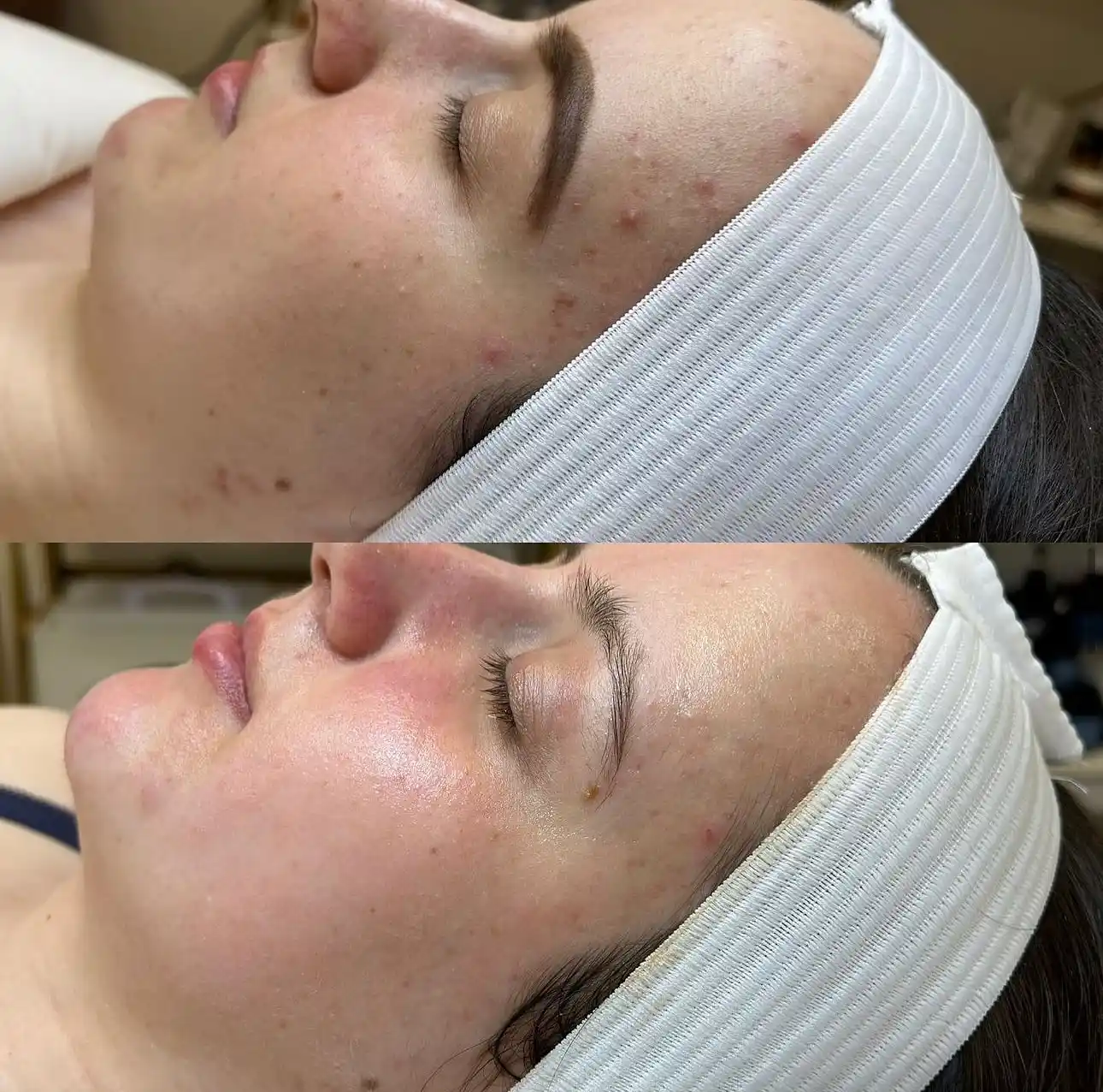 Side-by-side comparison of a face with acne before and after treatment.