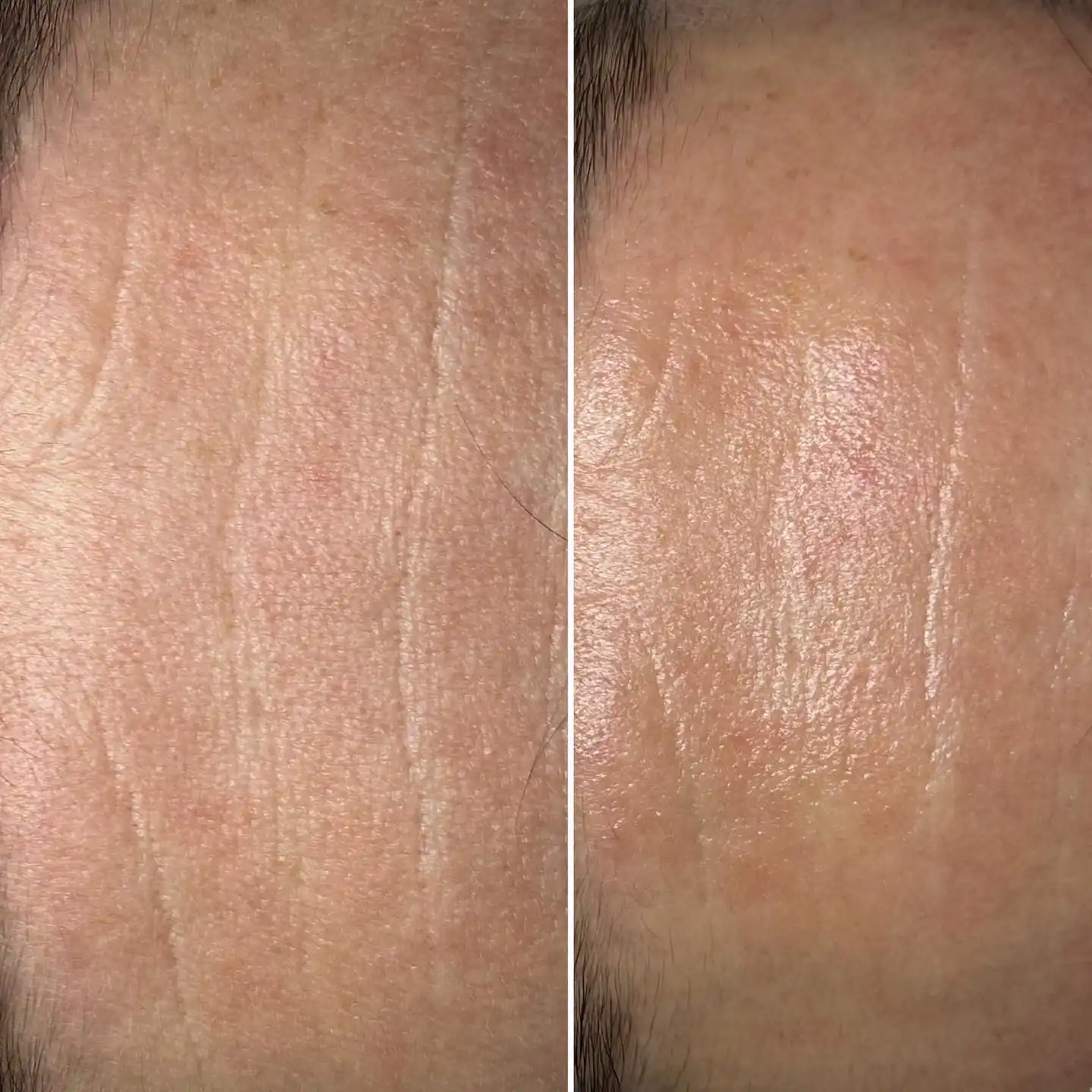 Forehead wrinkles before and after treatment at Skin Lounge Med Spa.