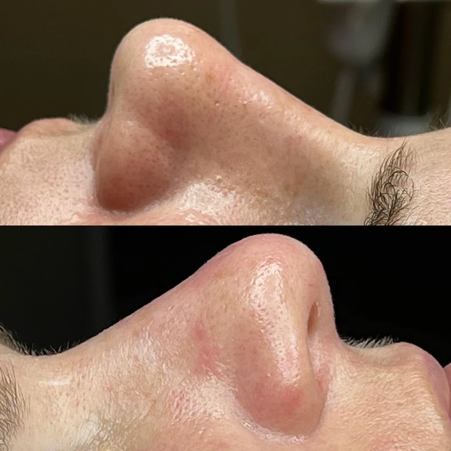 Before and after view of skin texture on a nose.