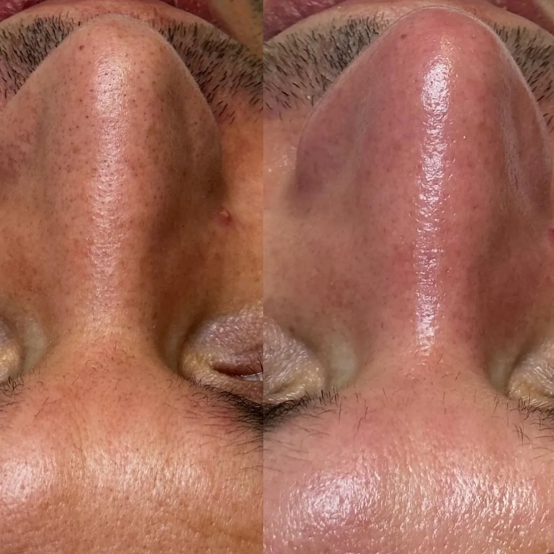 instagram nose before after treatment