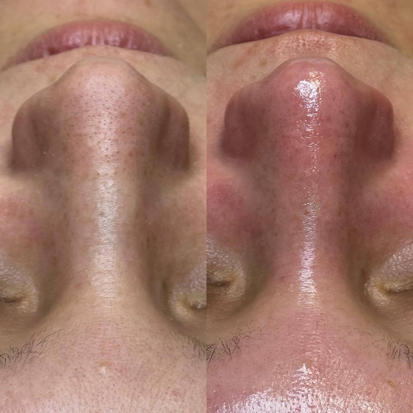 Nose pores before and after treatment at Skin Lounge Med Spa.