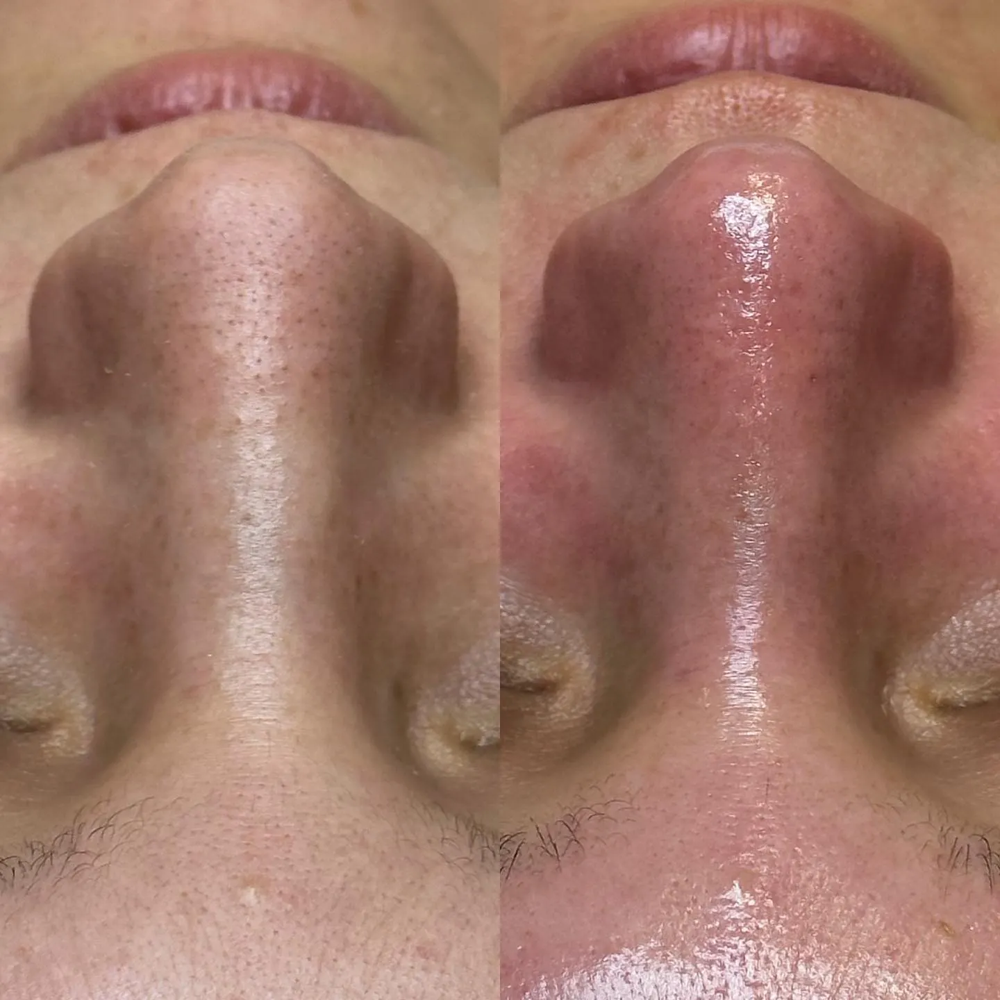 Nose pores before and after treatment at Skin Lounge Med Spa.