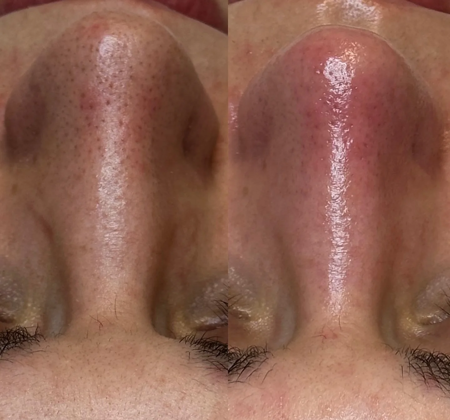 Before and after nose treatment at Skin Lounge Med Spa, Boca Raton, Florida.