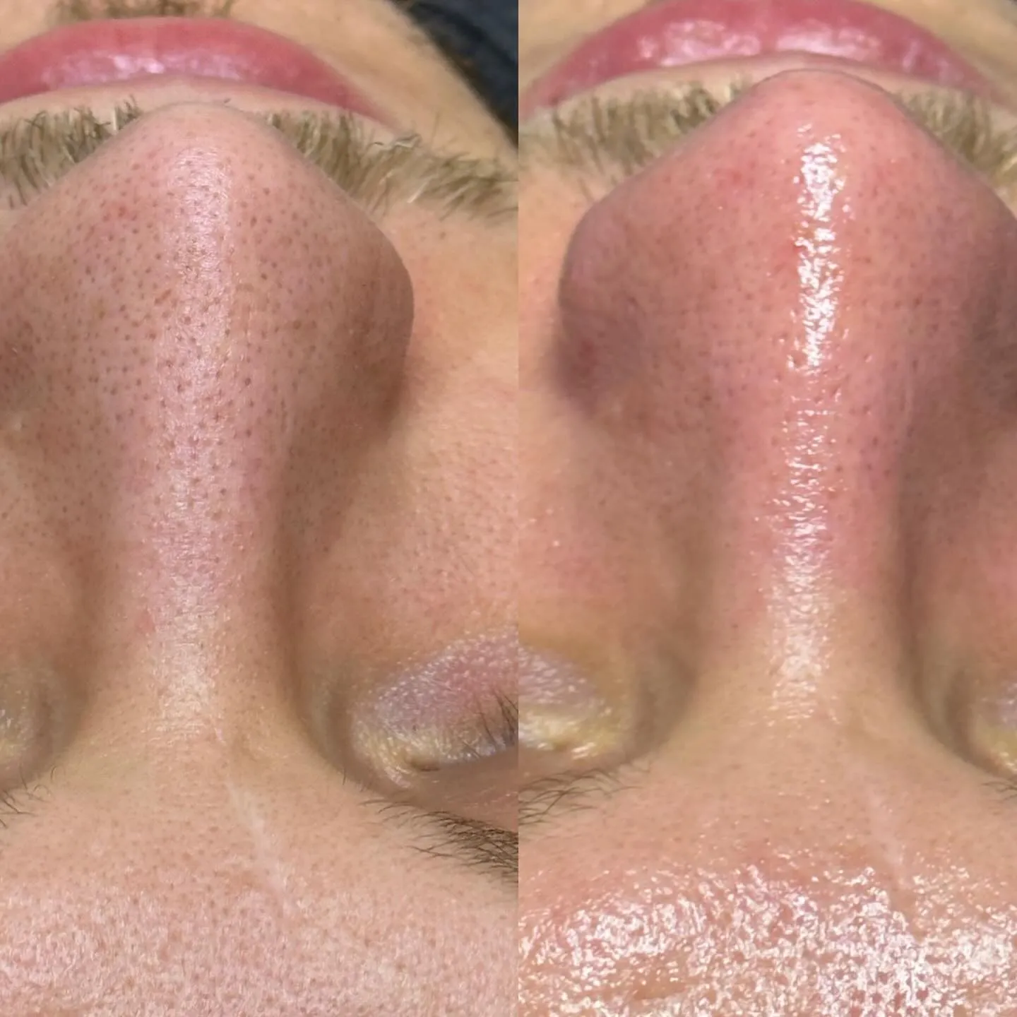 Before and after nose treatment at Skin Lounge Med Spa.