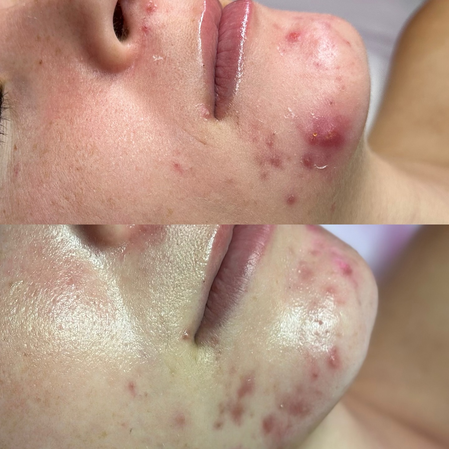 nn Close up of chin with acne before and after treatment.