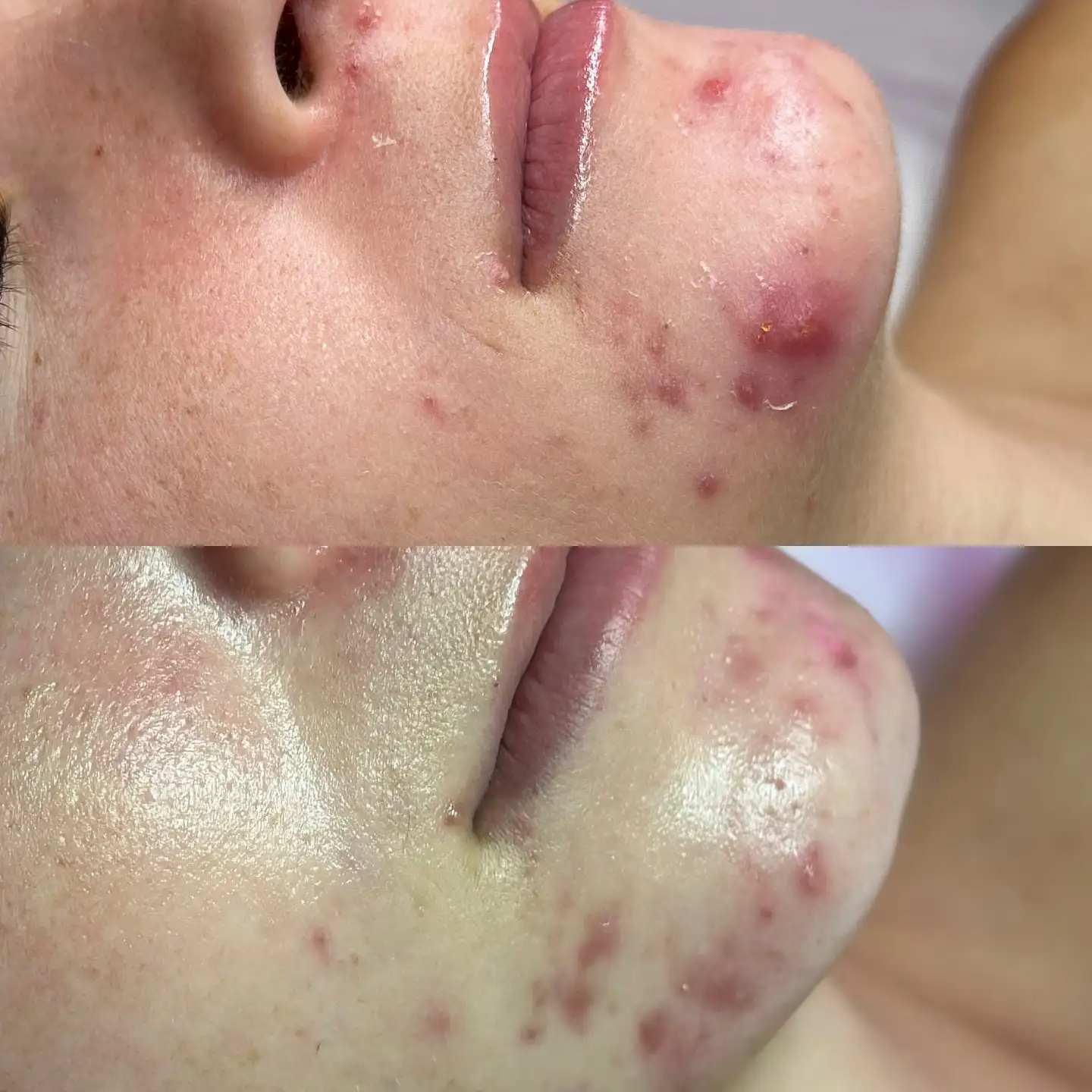 nn Close up of chin with acne before and after treatment.