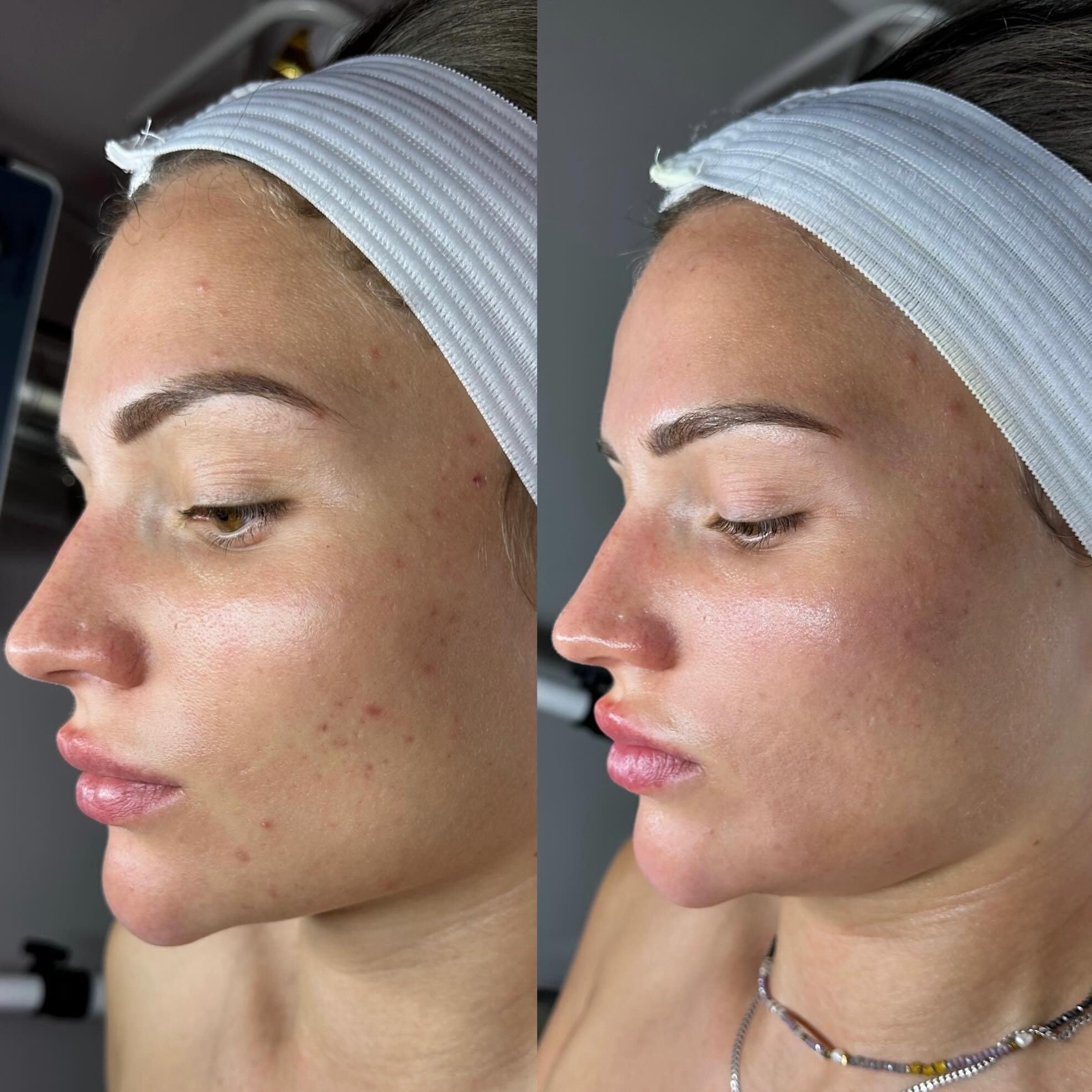 Before and after of a woman's face showing skin improvement.