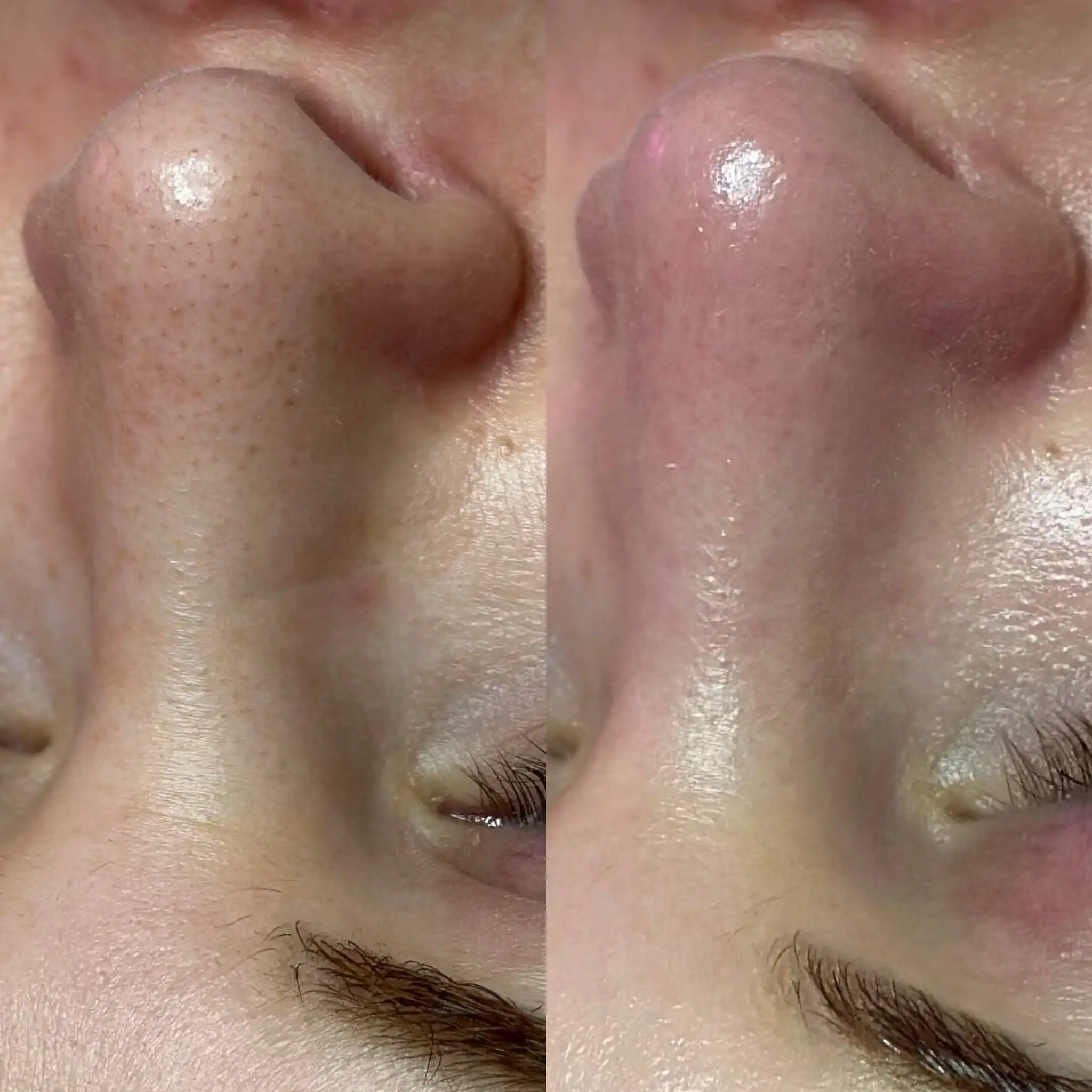 Side-by-side comparison of skin texture on a nose before and after treatment.