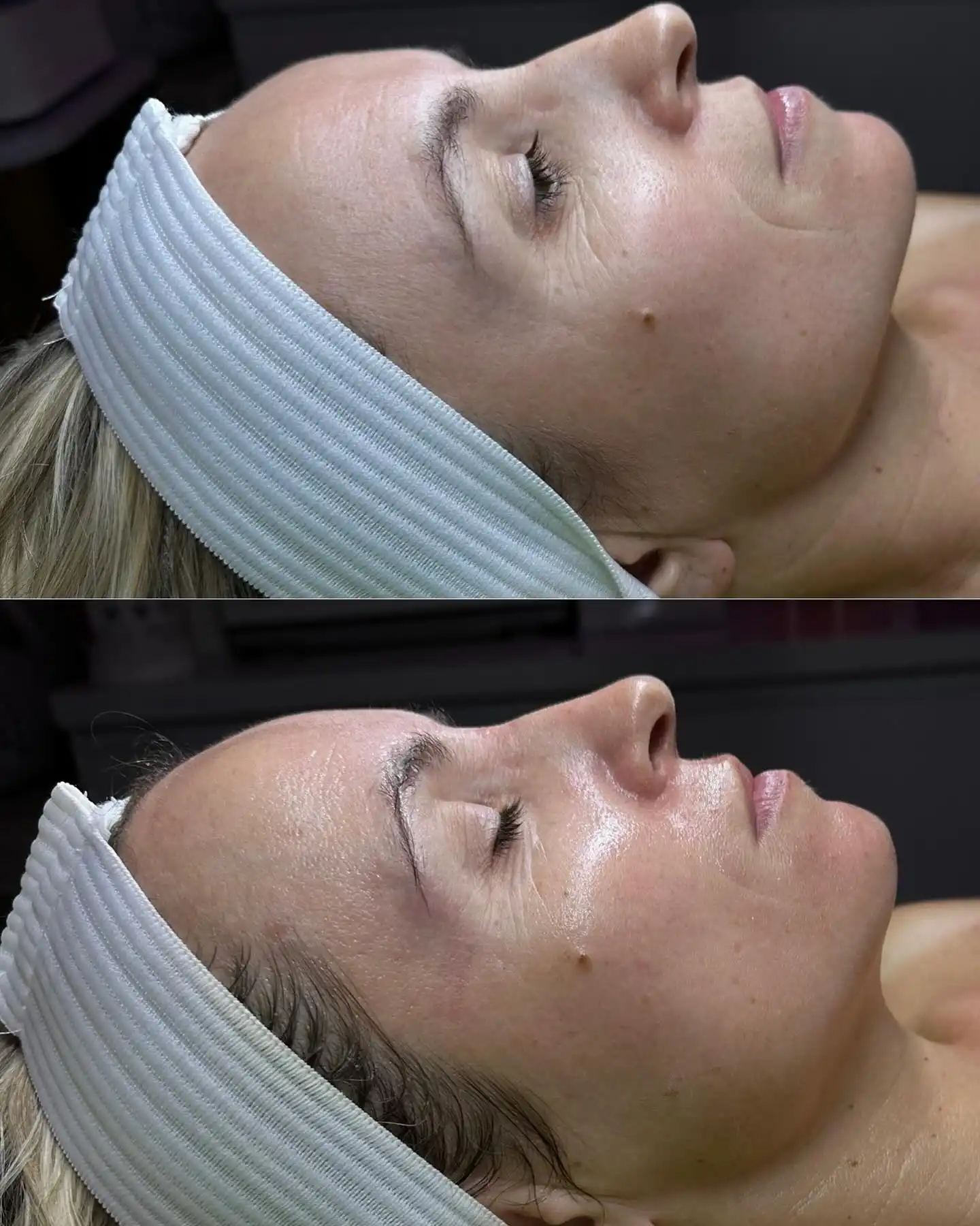 Side profile of a woman's face before and after a facial treatment.